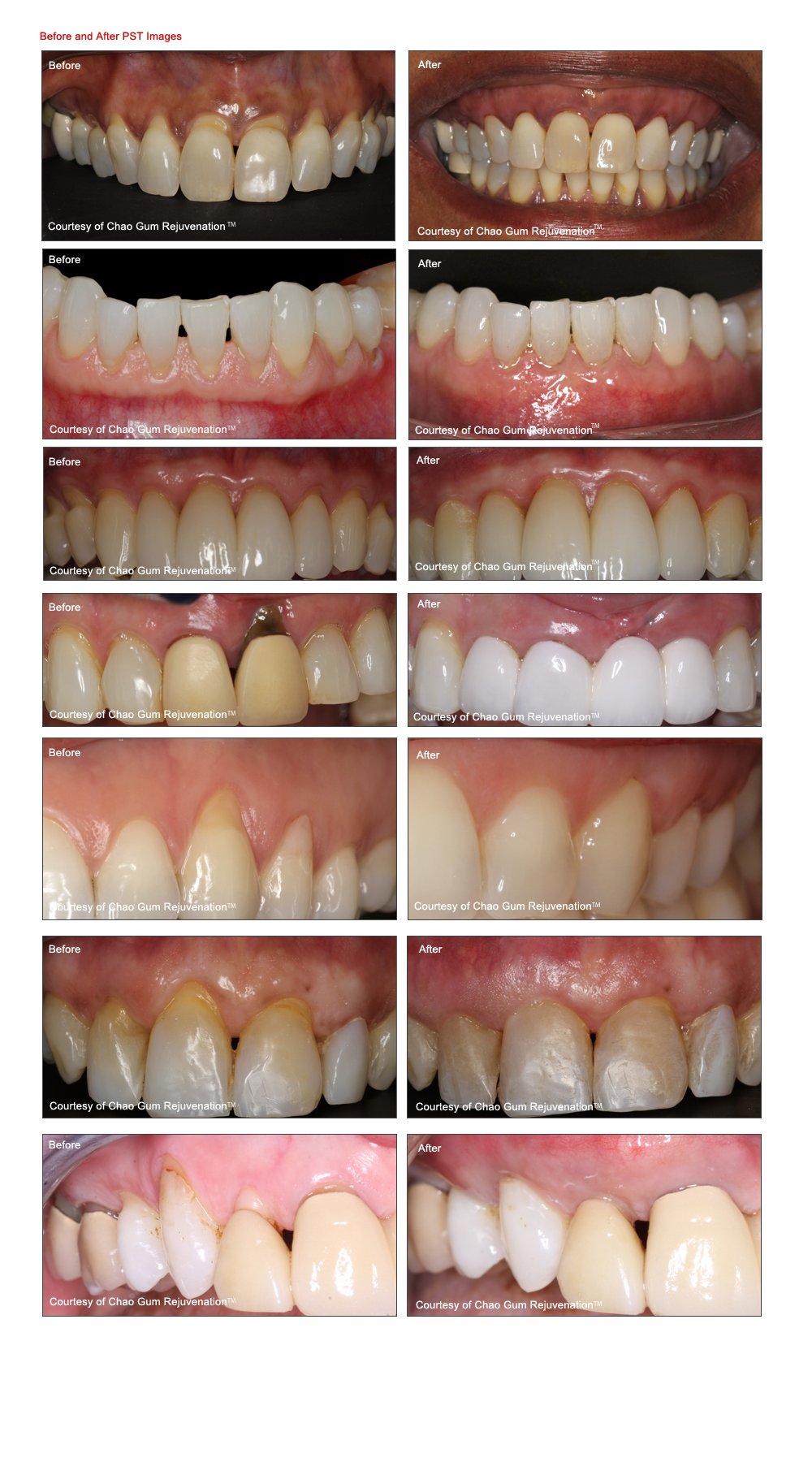 Before and after photos of the Pinhole Surgical Technique